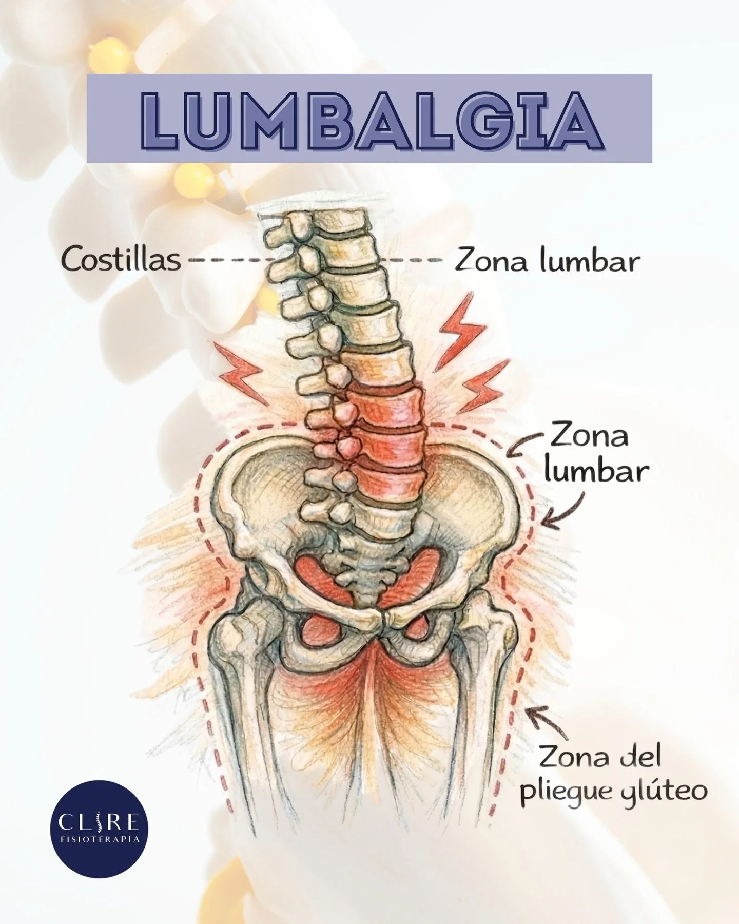 La lumbalgia es uno de los motivos de consulta m&aacute;s frecuentes en Clire Fisioterapia 📍👋🏻

📌 Puede estar relacionada con sobrecargas musculares, malas posturas, sedentarismo o esfuerzos repetitivos.

⚠️ Importante
No todas las lumbalgias son