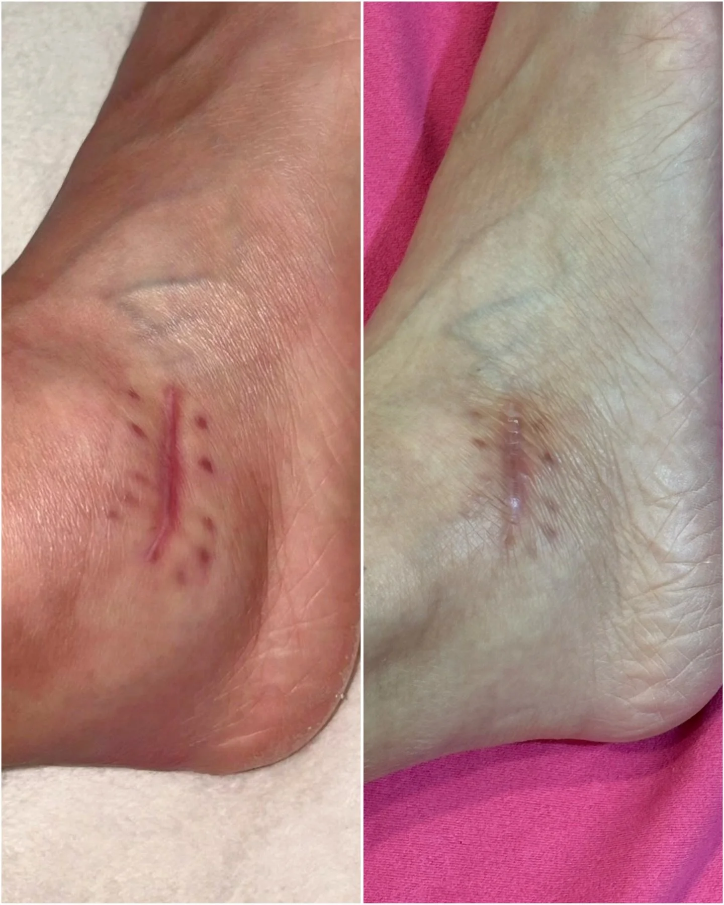 ✨ Caso Cl&iacute;nico: Recuperaci&oacute;n tras cirug&iacute;a de tobillo ✨

Os mostramos el caso de un paciente intervenido por una inestabilidad lateral cr&oacute;nica de tobillo, mediante reconstrucci&oacute;n ligamentosa del complejo lateral exte