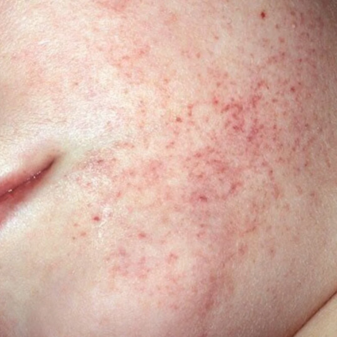 Leukemia Rashes, Infections, and Bruises