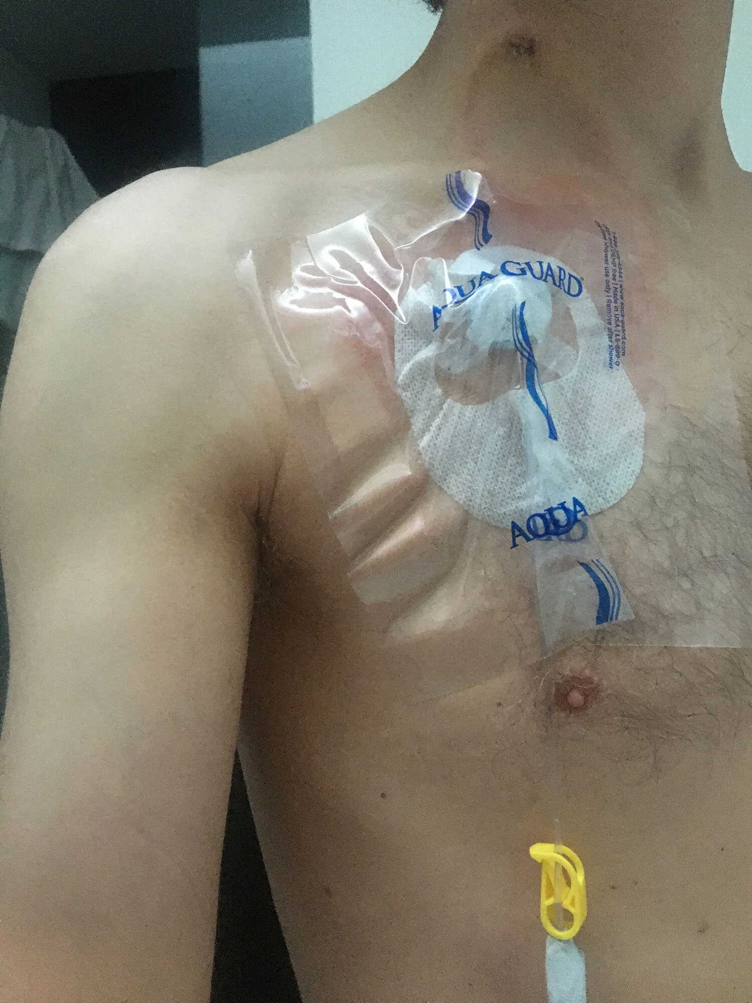 This is the port in my chest that the chemo would be pumped in to. 24/7. In this image it is covered with a protective plastic to keep it from getting wet in the shower. I was still going on trail runs with this thing but ultimately i switched to pi…