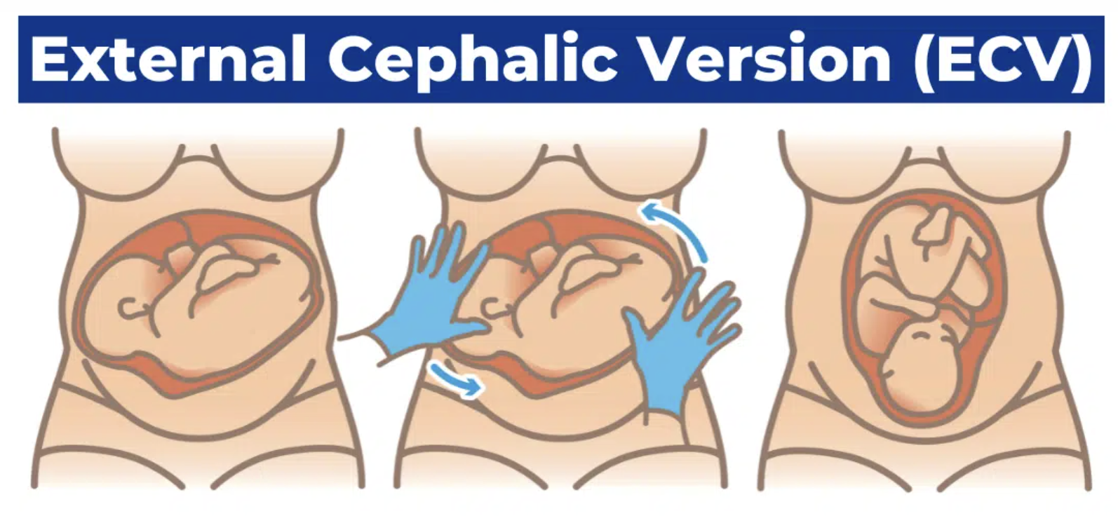 When Baby Is Breech: Understanding ECV