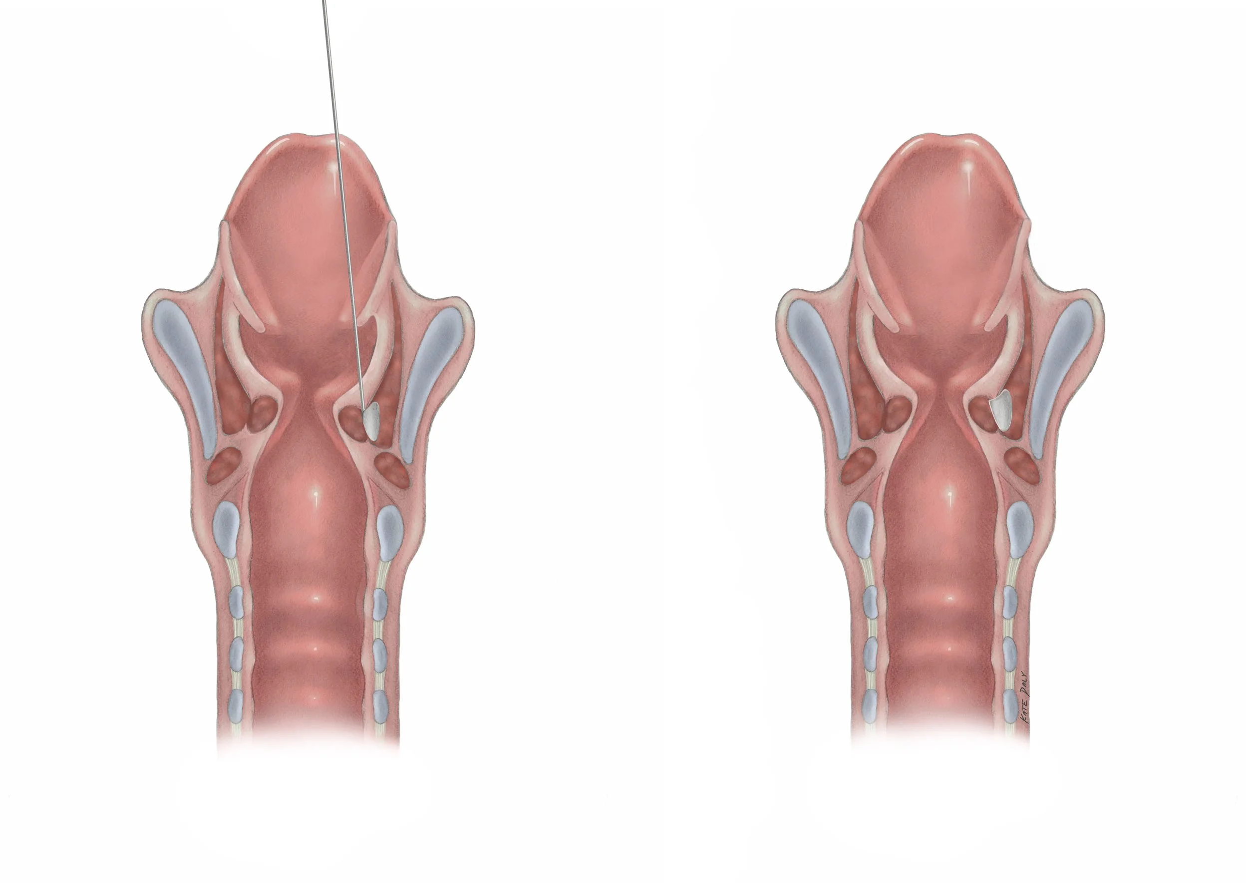 InjectionDepthRevised .jpg