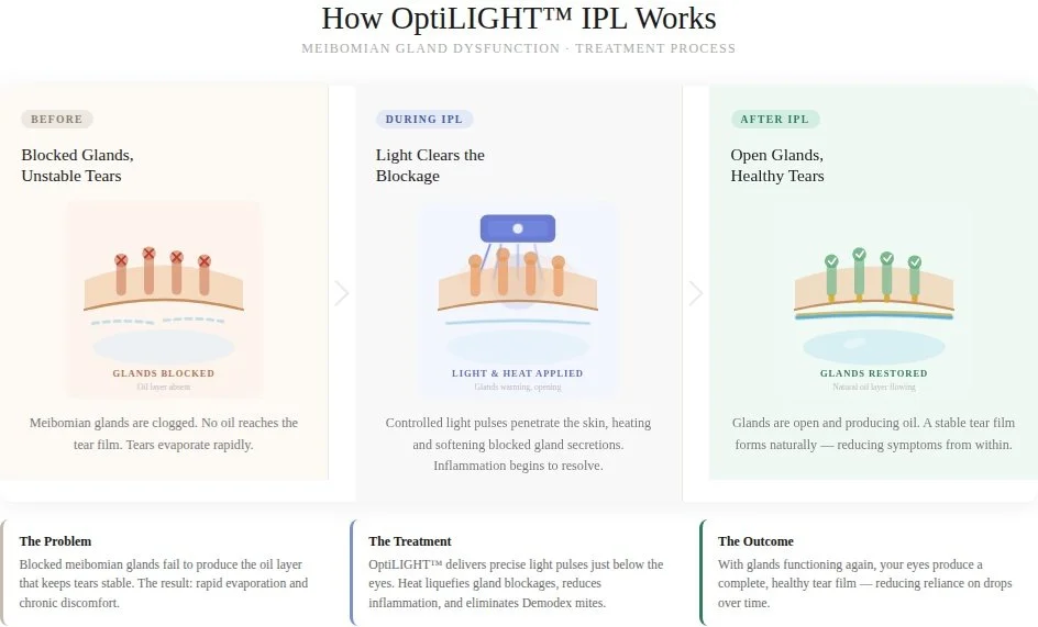 Punctal Plugs vs. IPL for Dry Eye