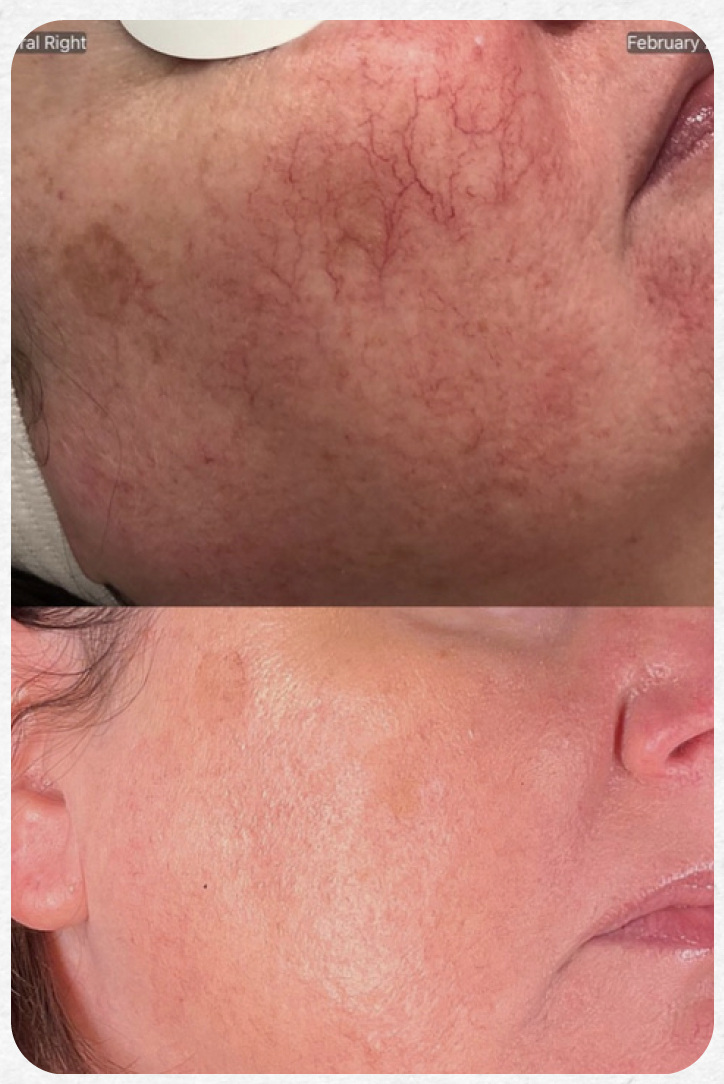 Photofacial Rosacea Results.png