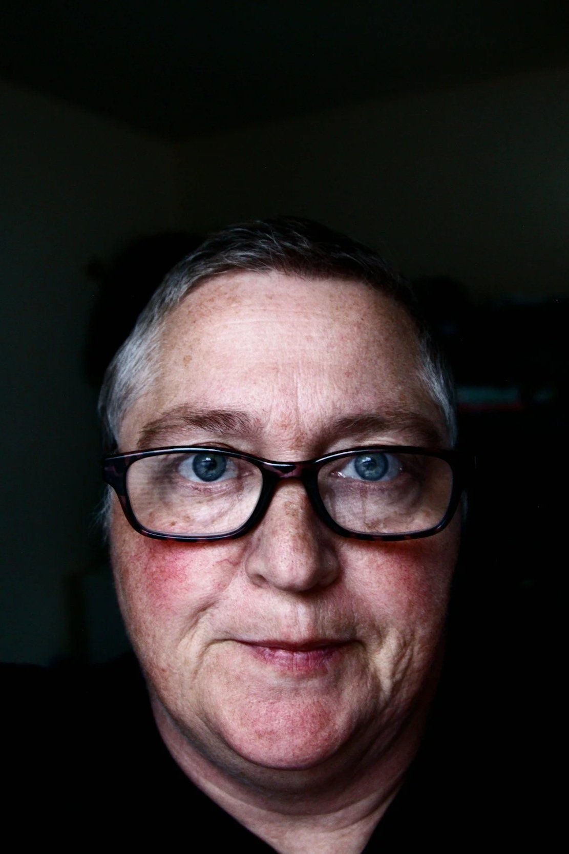 NYC Rosacea Patient Treatment