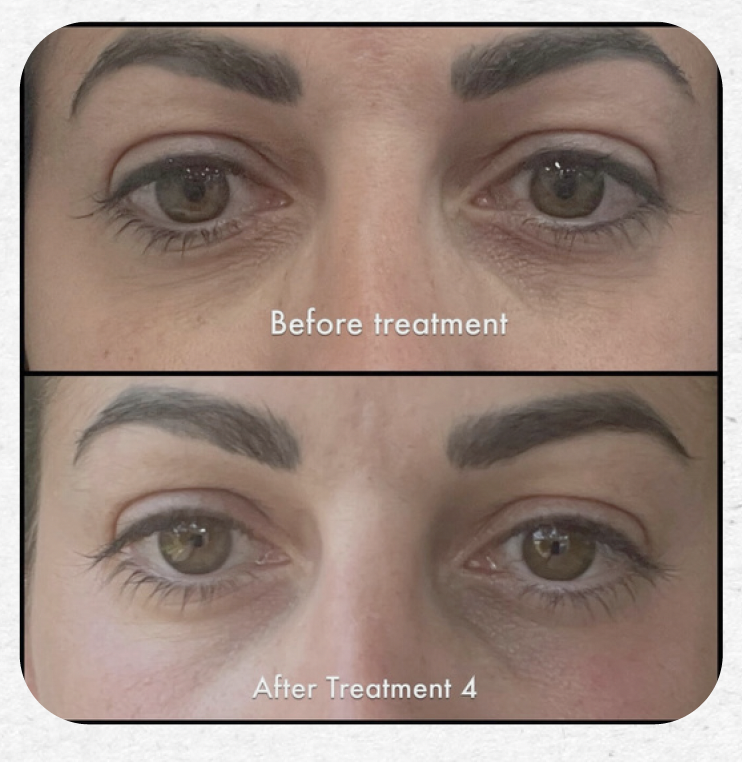 Strengthening Eyelids for tighter skin and a more refreshed appearance