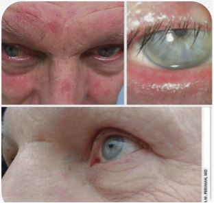 NYC Rosacea Treatment: IPL Can Be the Missing Piece