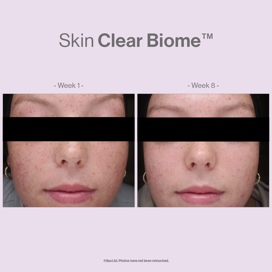 Advanced-Nutrition-Programme-Case-Study-Results_Social-Media-Skin-Clear-Biome-_KM116SC_Comparison.jpg
