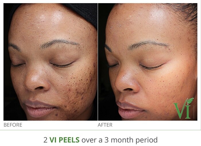 VI Peel Acne 6.jpg