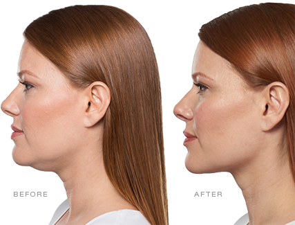 AboutKybella-medium.png