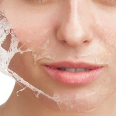 chemical-peel-philadelphia-1.jpg