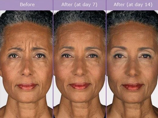 botox-before-and-after-pictures.jpg