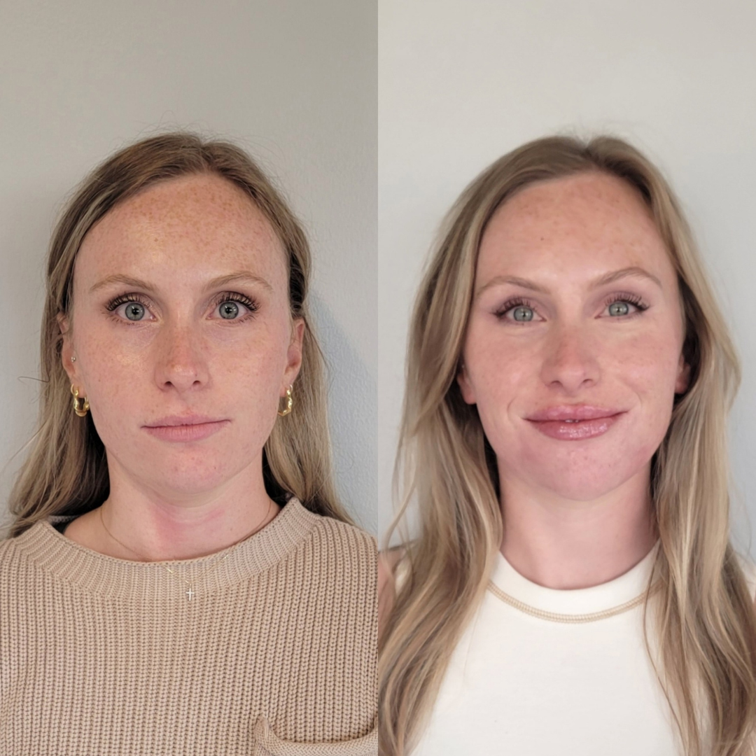 2026 Guide to Facial Balancing in Denver: What It Costs and Why It’s Worth It