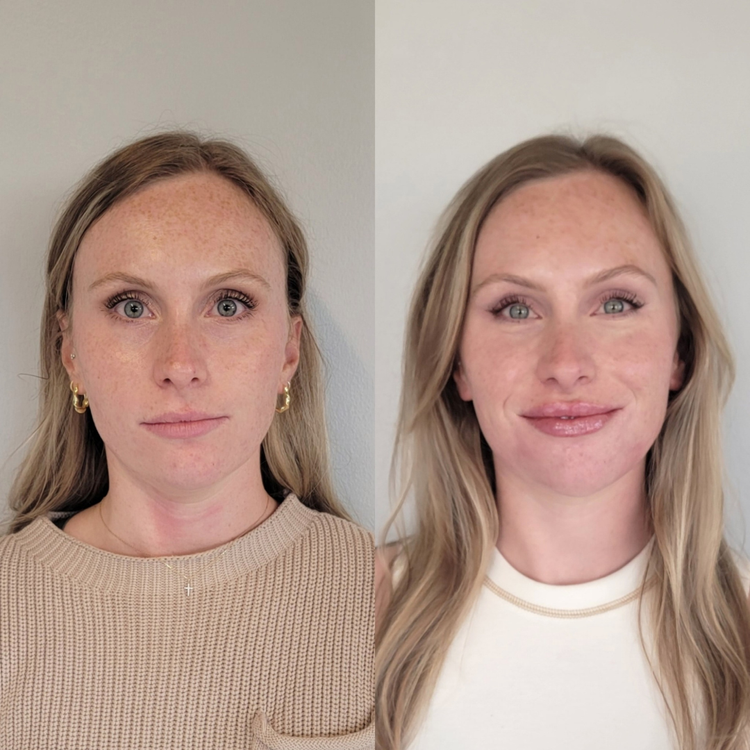 Before and after facial balancing at Cheeky Denver, patient five