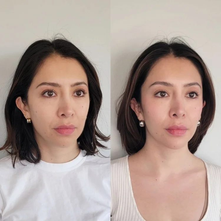 Before and after facial balancing at Cheeky Denver, patient two