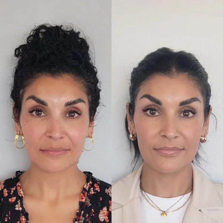 Before and after facial balancing at Cheeky Denver, patient three