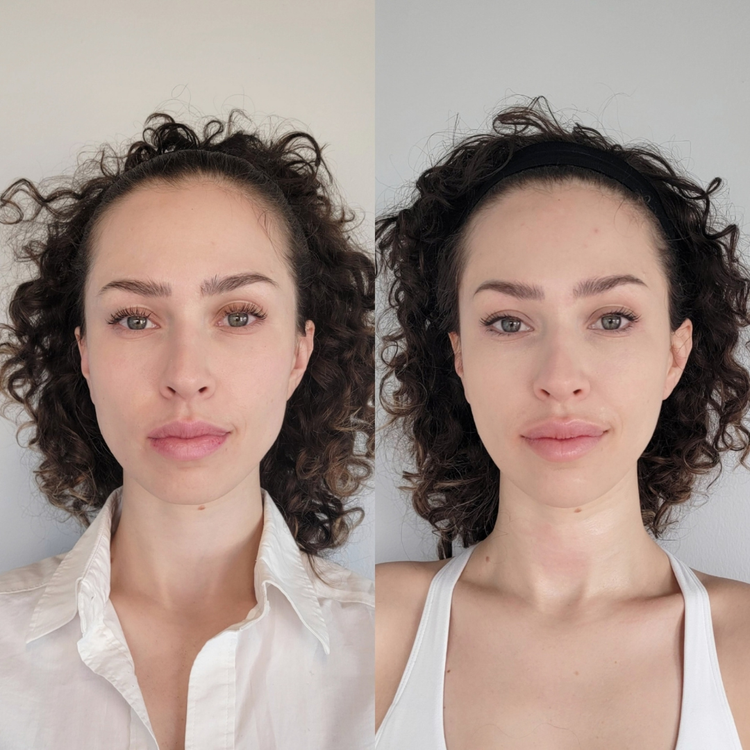 Before and after facial balancing at Cheeky Denver, patient one