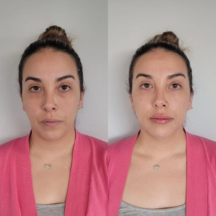 Before and after facial balancing at Cheeky Denver, patient four