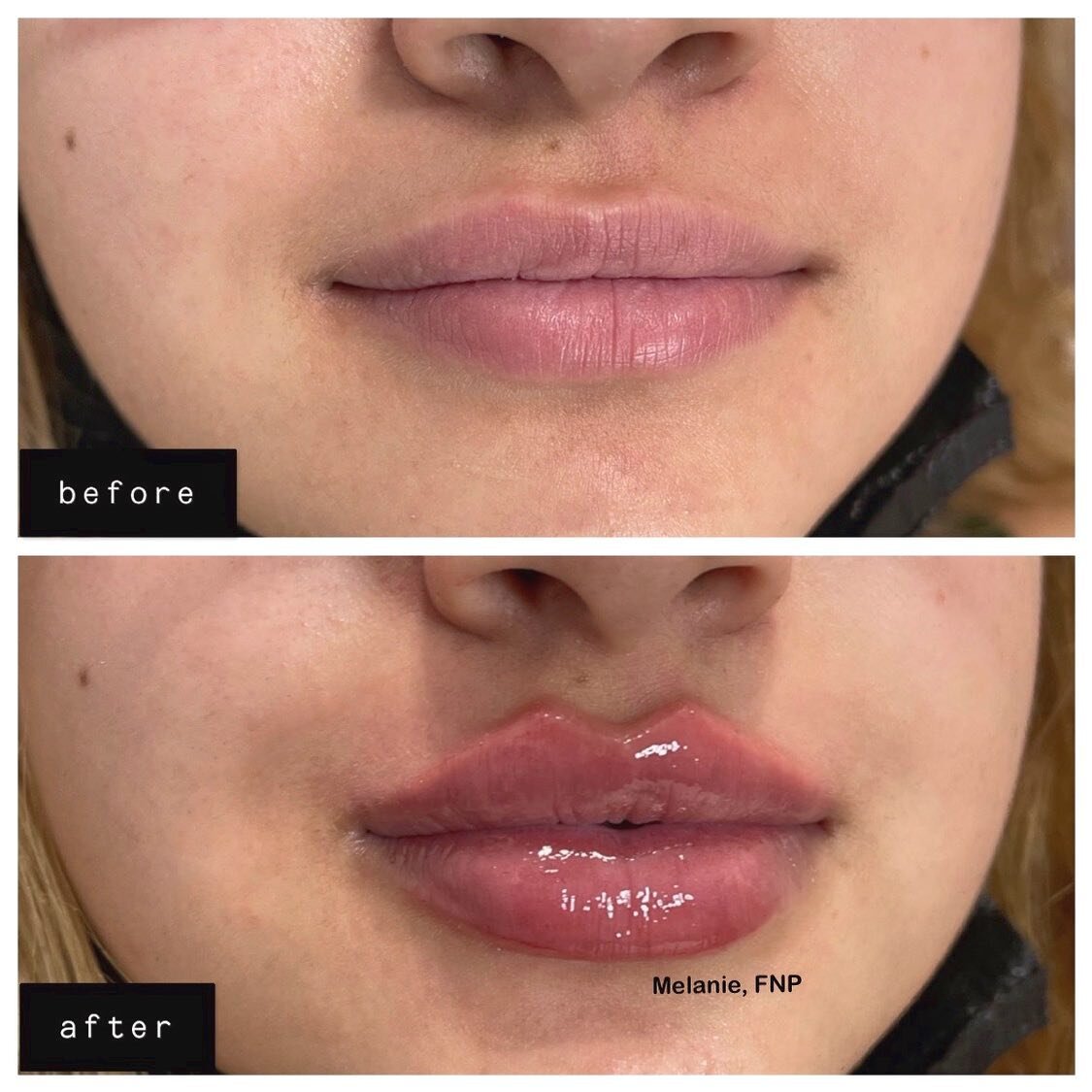 ✅RUSSIAN LIPS
✅BORDER REFINEMENT
✅KEYHOLE POUT

What do you guys think of these results?😻⬇️

#russianlips#Juvederm#Restylane#Voluma#Botox#Dysport#Kybella#aesthetics#dermalfiller#lipaugmentation#noseaugmentation#chinaugmentation#cheekenhancement#unde