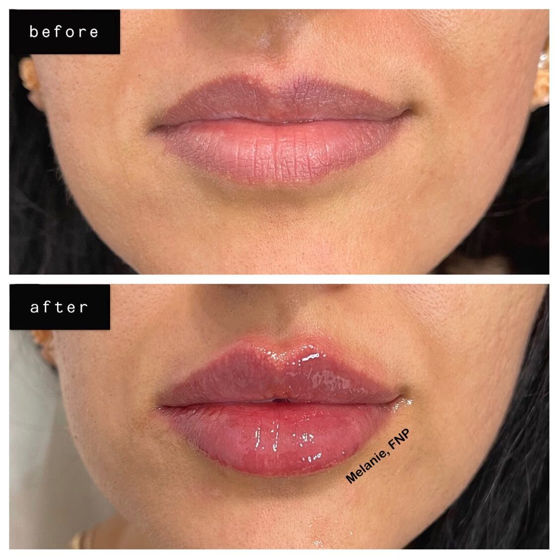 1 full syringe Juvéderm Ultra Plus XC💉
✅RUSSIAN LIPS
✅BORDER REFINEMENT
✅ASYMMETRY CORRECTION
✅KEYHOLE POUT

What do you guys think of these results?😻⬇️

#russianlips#Juvederm#Restylane#Voluma#Botox#Dysport#Kybella#aesthetics#dermalfiller#lipaugme