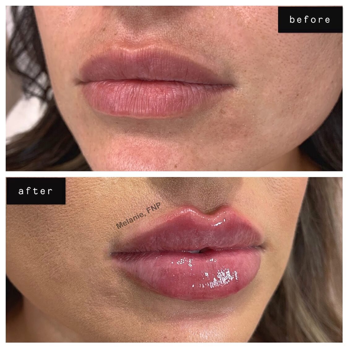 ✅RUSSIAN LIPS
✅BORDER REFINEMENT
✅KEYHOLE POUT

What do you guys think of these results?😻⬇️

#russianlips#Juvederm#Restylane#Voluma#Botox#Dysport#Kybella#aesthetics#dermalfiller#lipaugmentation#noseaugmentation#chinaugmentation#cheekenhancement#unde
