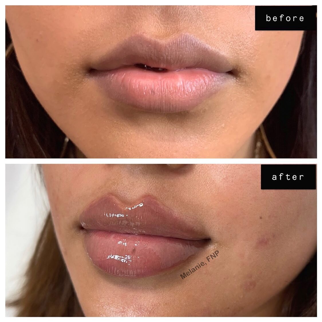 2 syringes done 6 months apart (final results photo was taken after 2nd syringe)💖
BORDER REFINEMENT + RUSSIAN LIPS

What do you guys think of these results?😻⬇️

#russianlips#Juvederm#Restylane#Voluma#Botox#Dysport#Kybella#aesthetics#dermalfiller#li