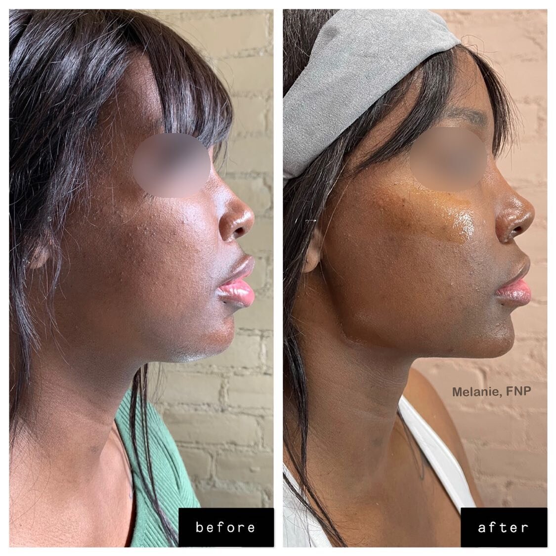 The before photo was taken January 2020
The after photo was taken February 2021

Please note: All treatments were spread out across 6 treatment dates, and not done all at once. 

Full list of treatments done:
💥Several Kybella treatments
💦Cheek Augm