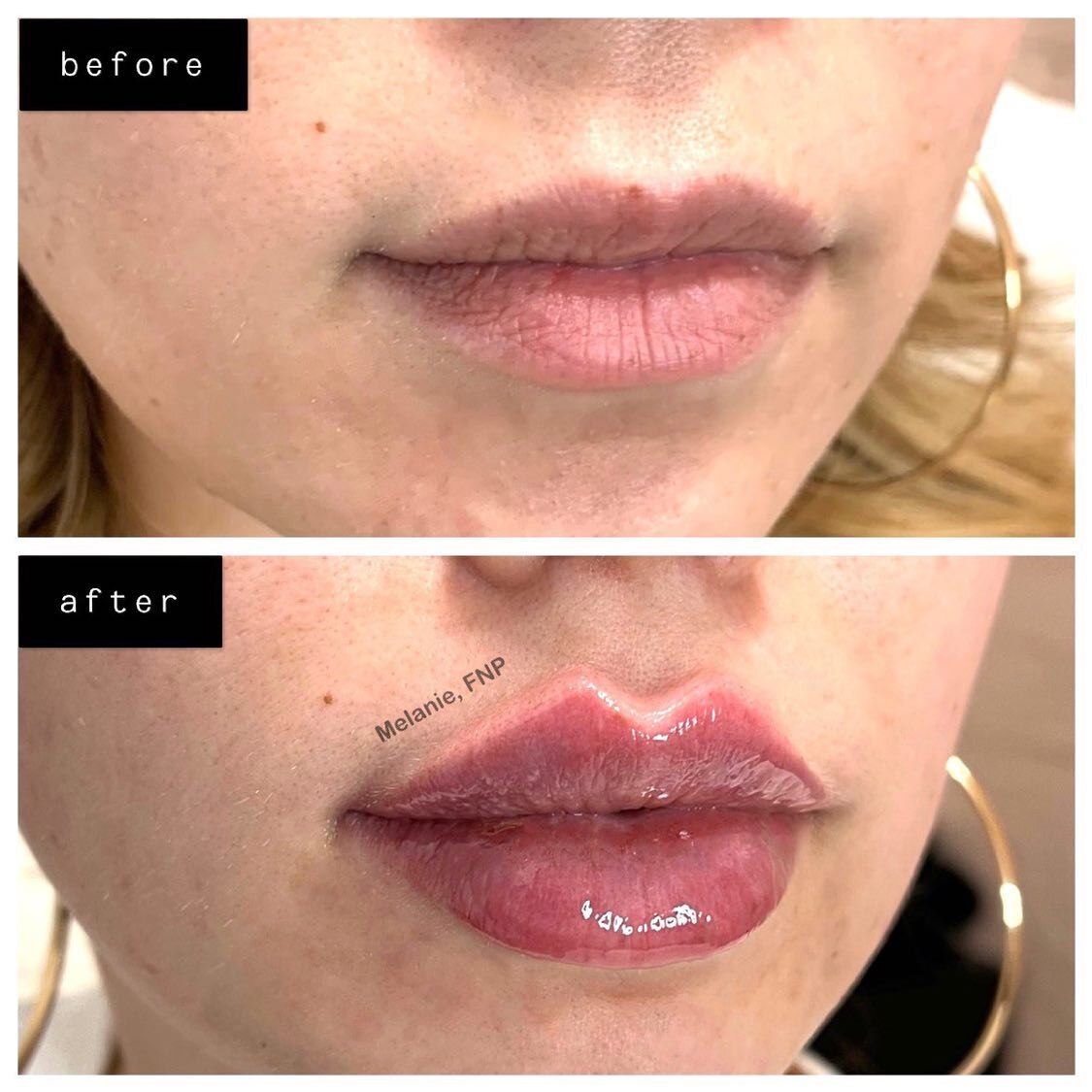 2 syringes done 5 months apart (final results photo was taken after 2nd syringe)💖
✅BORDER REFINEMENT
✅RUSSIAN LIPS
✅KEYHOLE POUT

What do you guys think of these results?😻⬇️

#russianlips#Juvederm#Restylane#Voluma#Botox#Dysport#Kybella#aesthetics#d