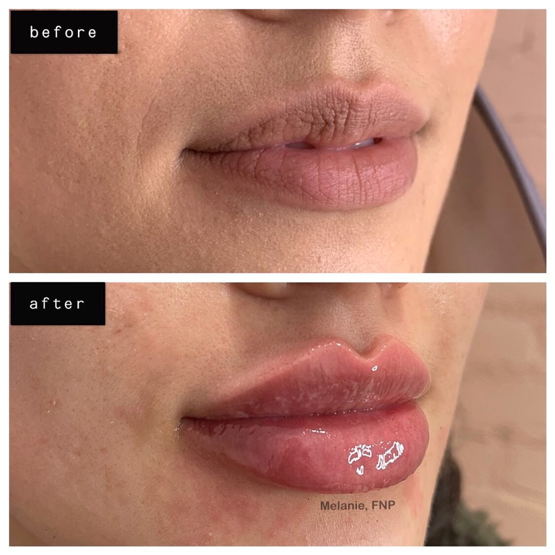2 SYRINGES TO CREATE THESE SAUCEY RUSSIAN LIPS (no filler above or below the lip line)💉👄
#russianlips#Juvederm#Restylane#Voluma#Botox#Dysport#Kybella#aesthetics#dermalfiller#lipaugmentation#noseaugmentation#chinaugmentation#cheekenhancement#underey
