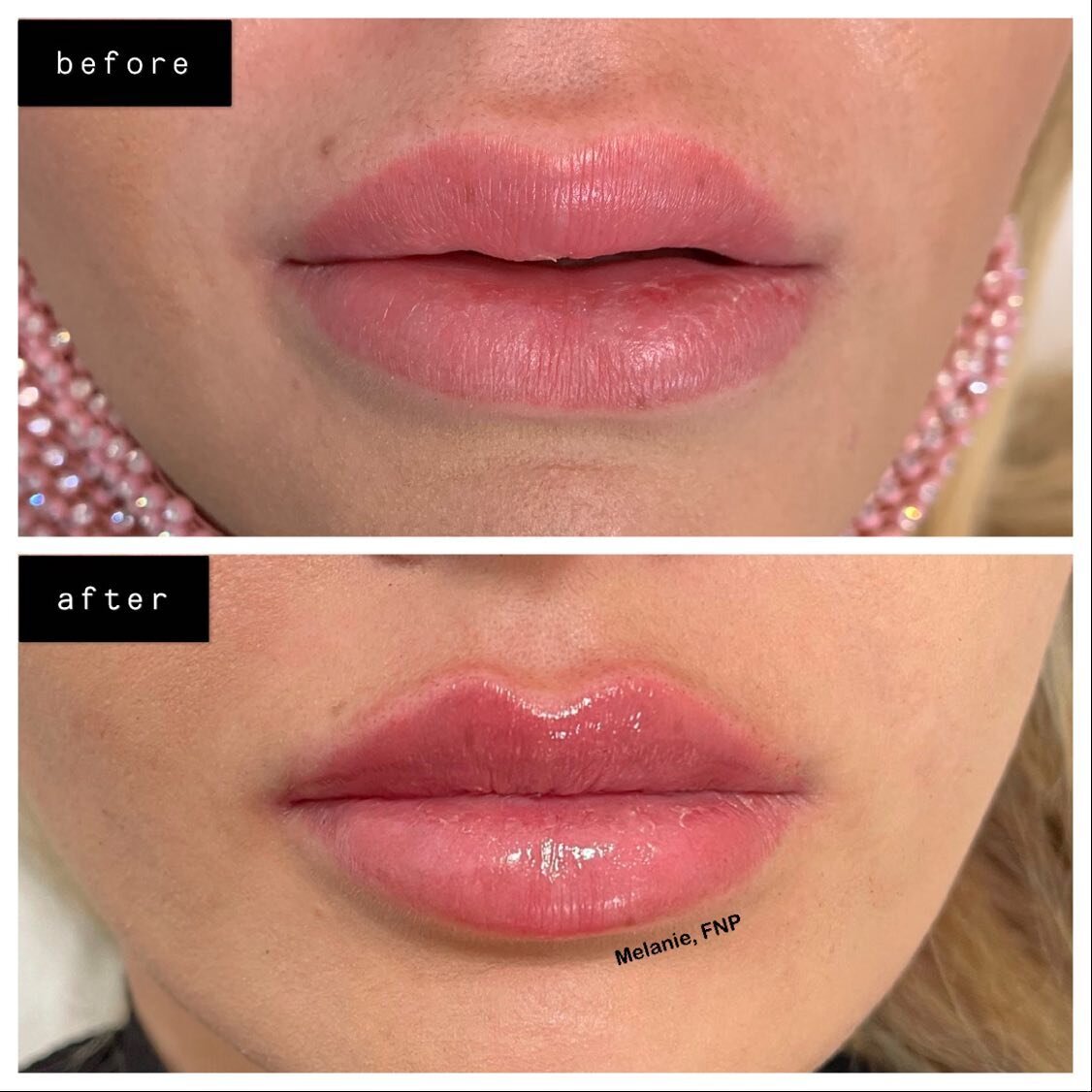 CORRECTION+RUSSIAN LIPS👄💉
{{SWIPE⏮}}
Patient came in unhappy with her lip shape done by previous injectors. One session of dissolver was done to remove unwanted/misplaced filler in different parts of the lip, then 1 full syringe of filler added to 