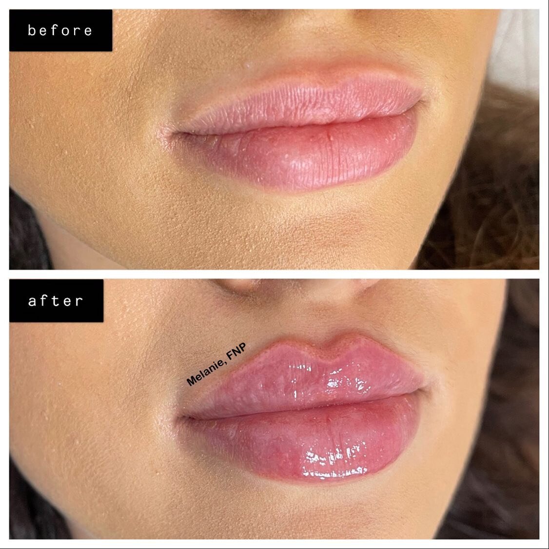 ✅ASYMMETRY CORRECTION
✅BORDER REFINEMENT
✅RUSSIAN LIPS

What do you guys think of these results?😻⬇️

#Juvederm#Restylane#Voluma#Botox#Dysport#Kybella#aesthetics#dermalfiller#lipaugmentation#noseaugmentation#chinaugmentation#cheekenhancement#undereye
