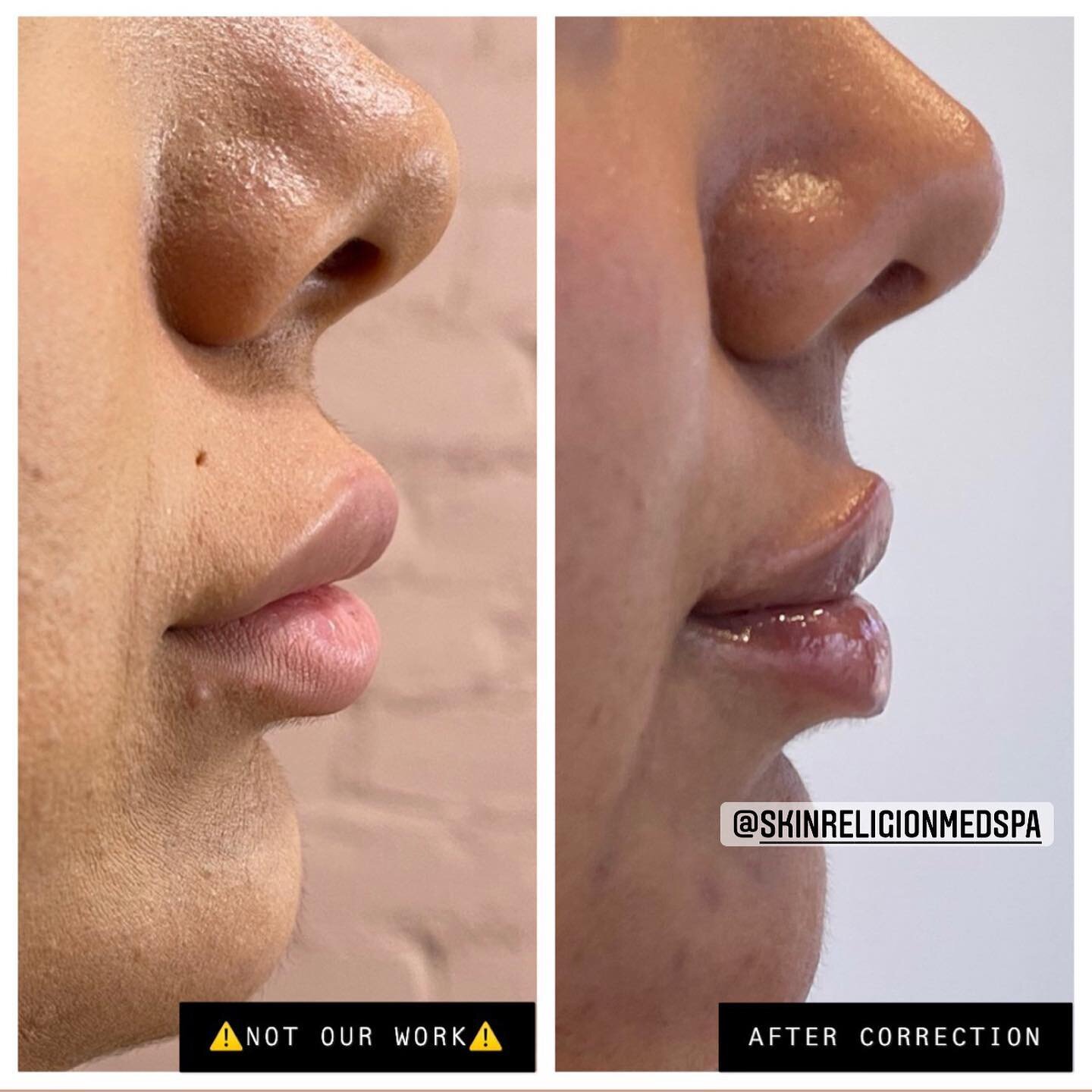 MAJOR CORRECTION RESULTS:

This lovely client came in wanting the #russianliptechnique but unfortunately needed 3 sessions of dissolver for the &ldquo;shelf&rdquo; she had above her lip line. We dissolved her and redid her lips!

The #russiantechniqu
