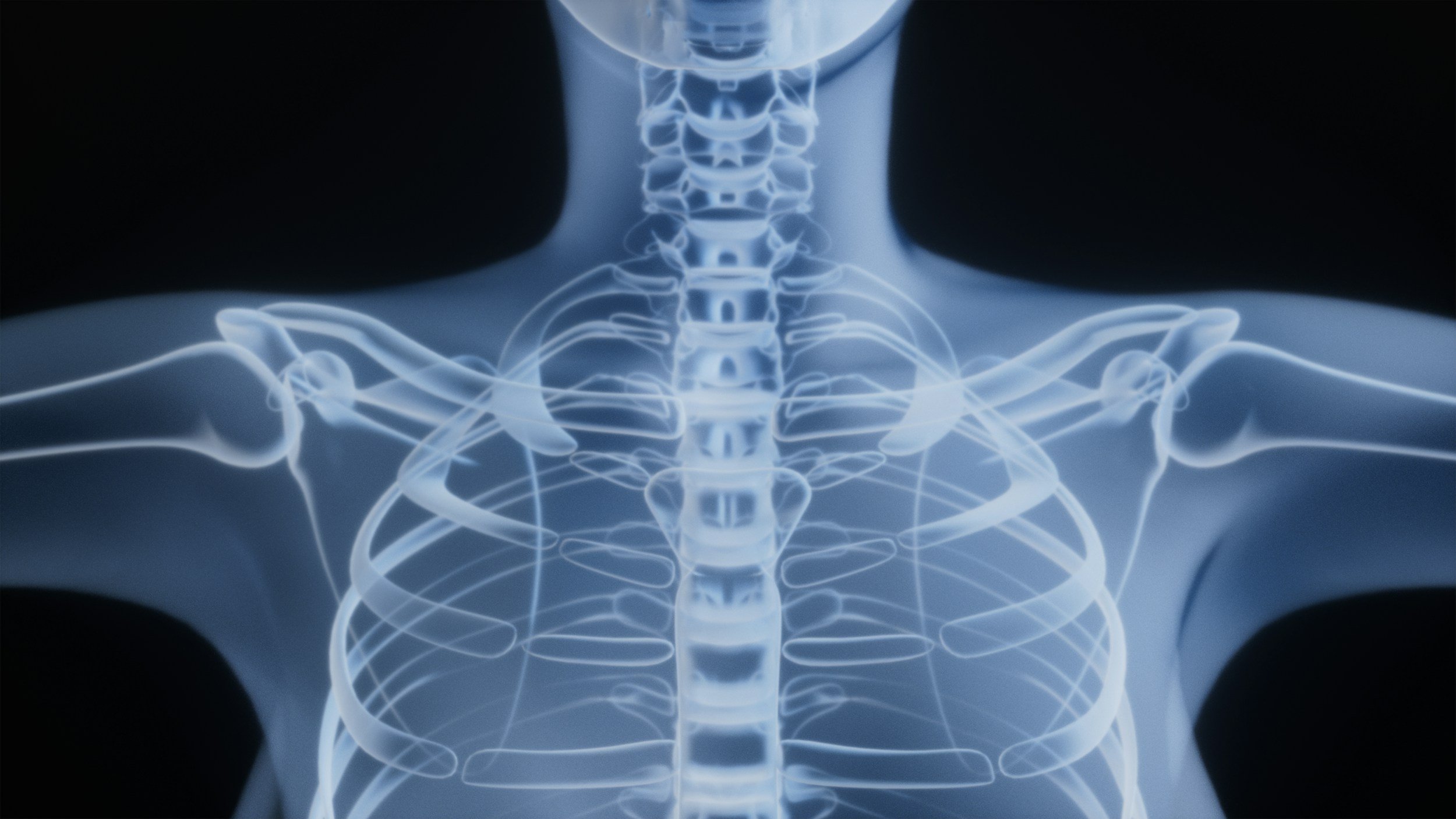First Rib Dysfunction and Nerve Symptoms: Can the First Rib Cause Arm Pain, Tingling and Numbness?