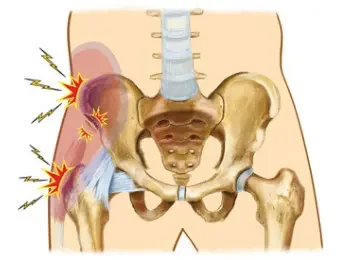 Hip Pointer Injury: Causes, Symptoms, Treatment and Recovery