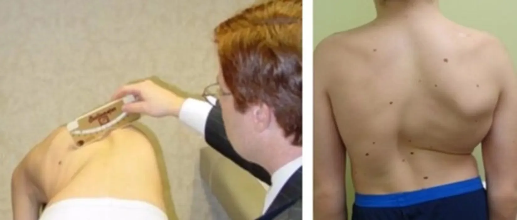 Understanding Paediatric Scoliosis — EPOCH HEALTH