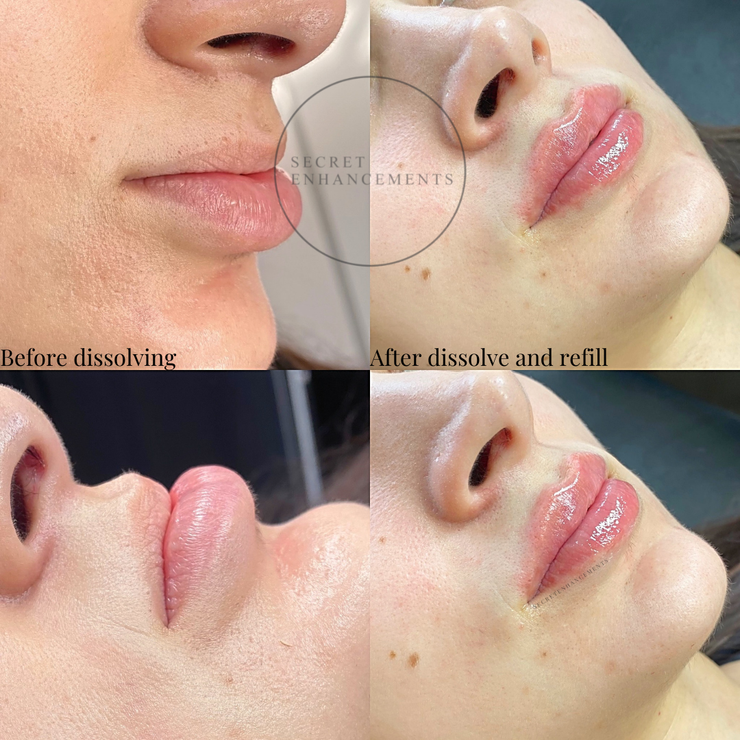 lip filler dissolving Milton Keynes
