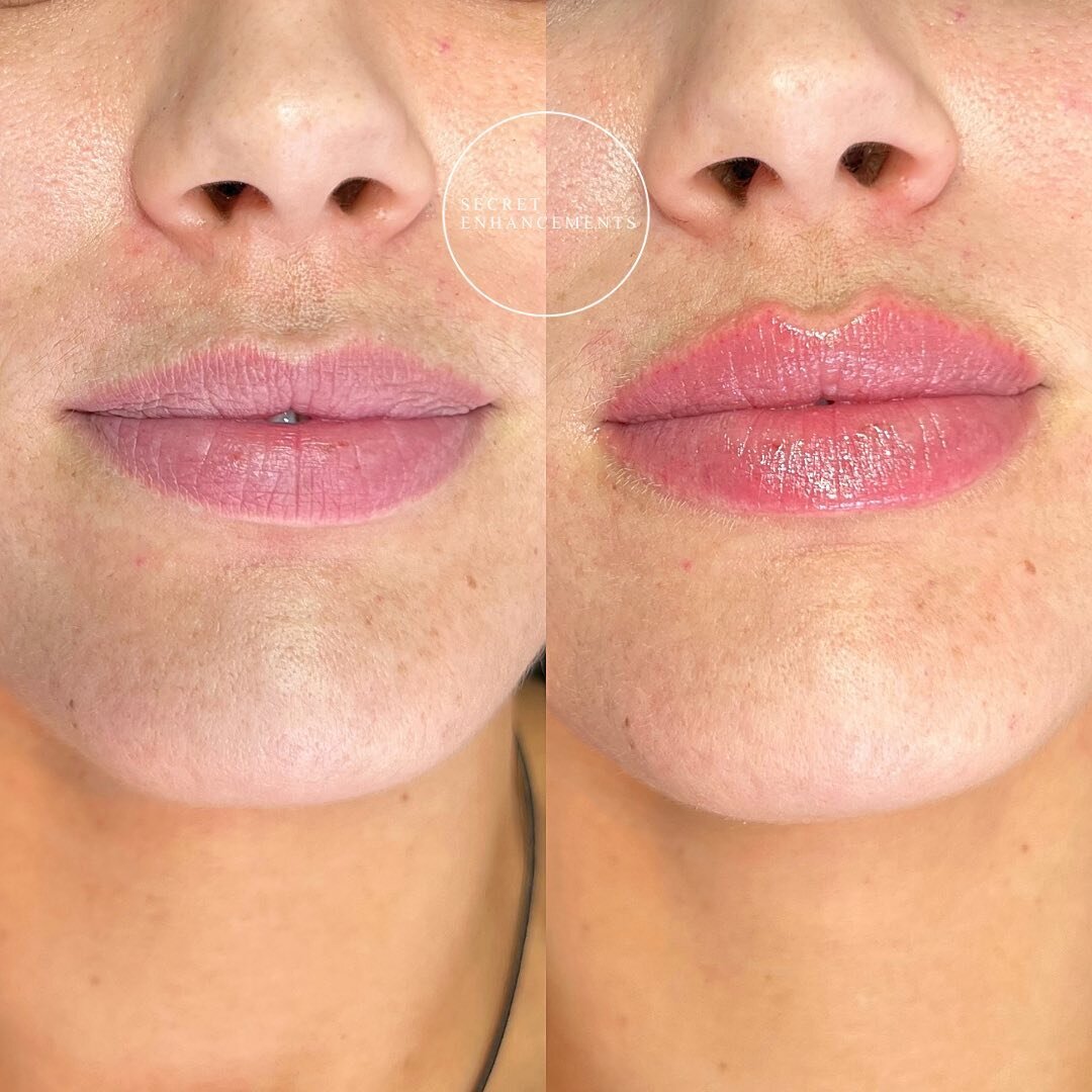 PROOF that you can still have lip filler and look like YOU 😍

At Secret Enhancements, we keep results as natural as possible and aim not to completely change your features, but ENHANCE what you already have, so that YOU stay looking like YOU! 👌🏽

