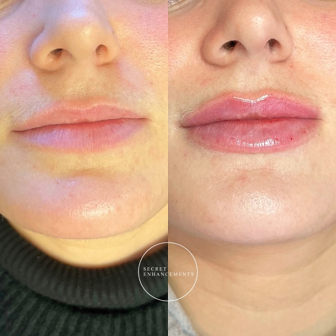 Natural lip filler all the way 🪄✨✅
