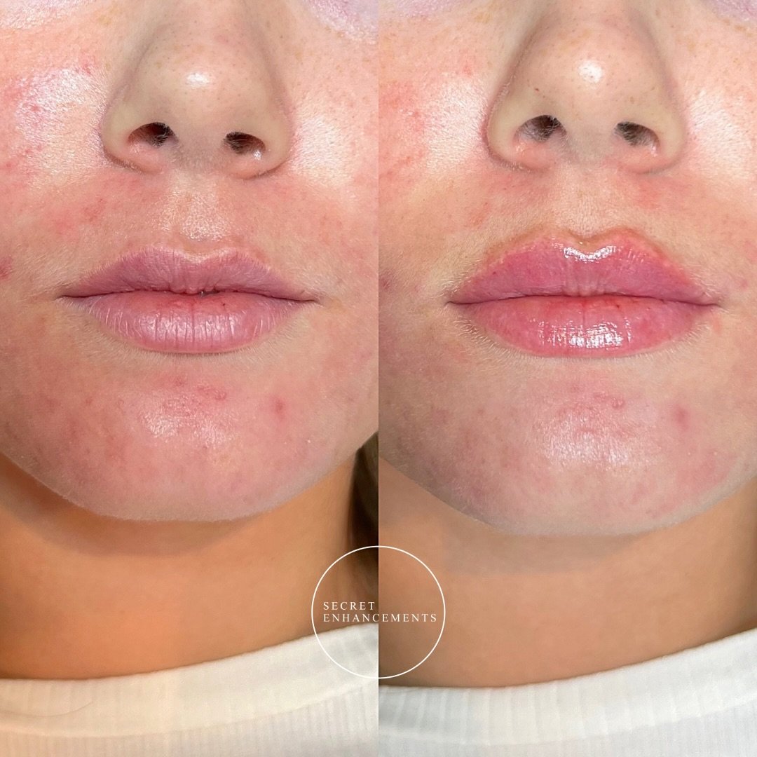 Natural lip filler in Milton Keynes ✅✨