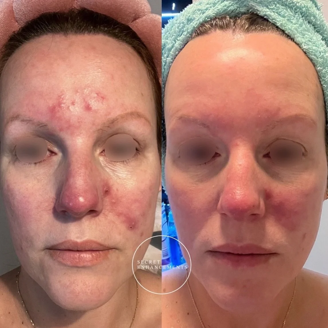 What. A. transformation! ✨ 

After just 1 in-clinic resurfacing treatments and consistent use of our new pHformula kit targeting redness and rosacea, this client&rsquo;s skin is visibly calmer, more even-toned, and breakout-free. 

Redness has signif