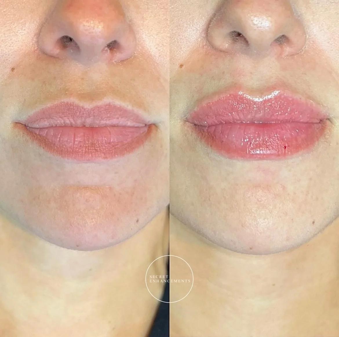 Natural lip filler in Milton Keynes! 🪄✨🫶🏽