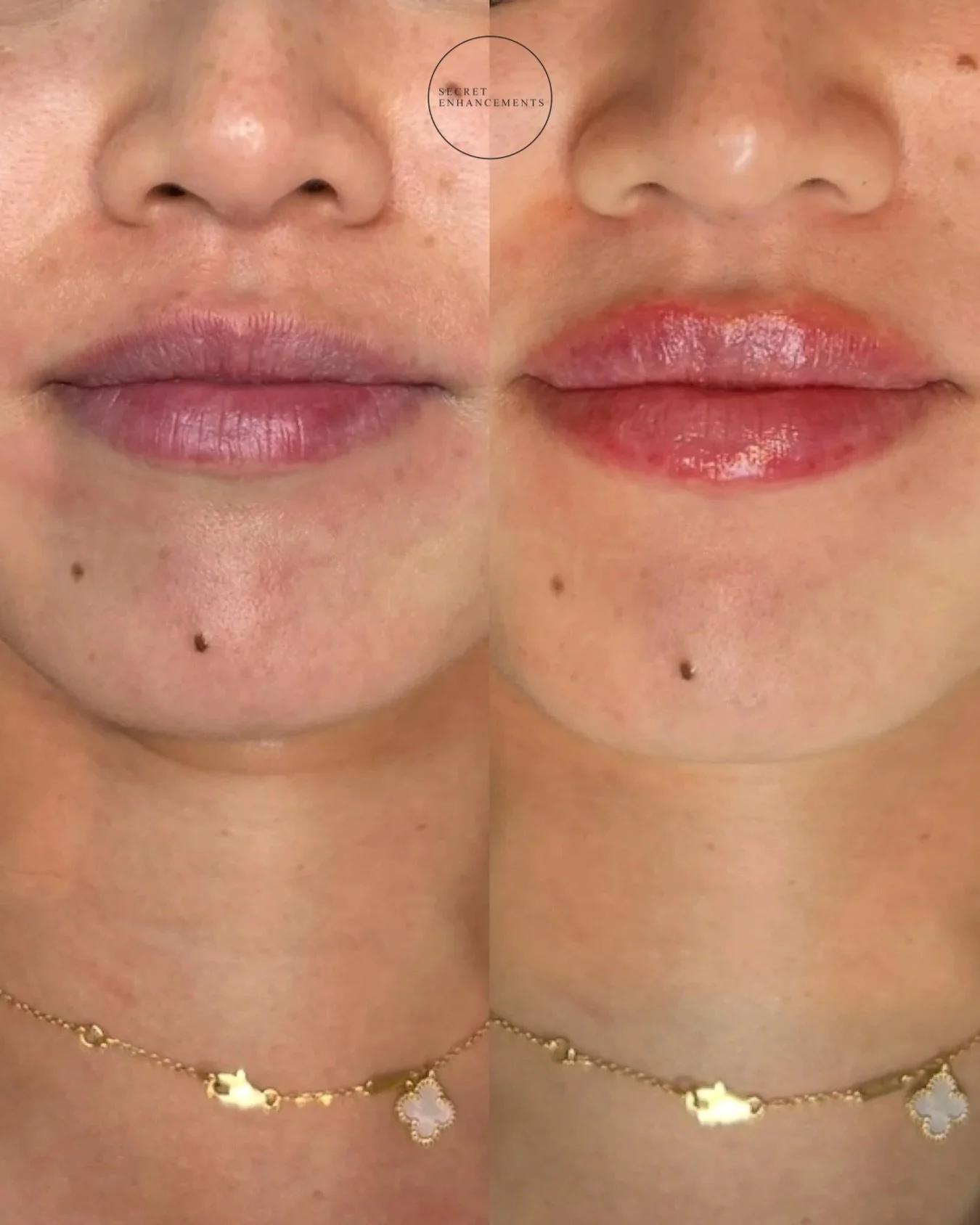 Natural, plumper lips, perfectly balanced for your face.

Here&rsquo;s a beautiful before &amp; after from our lip filler treatment in Milton Keynes 💉

We specialise in creating subtle, natural enhancements.

📍 Clinic: Secret Enhancements, Milton K