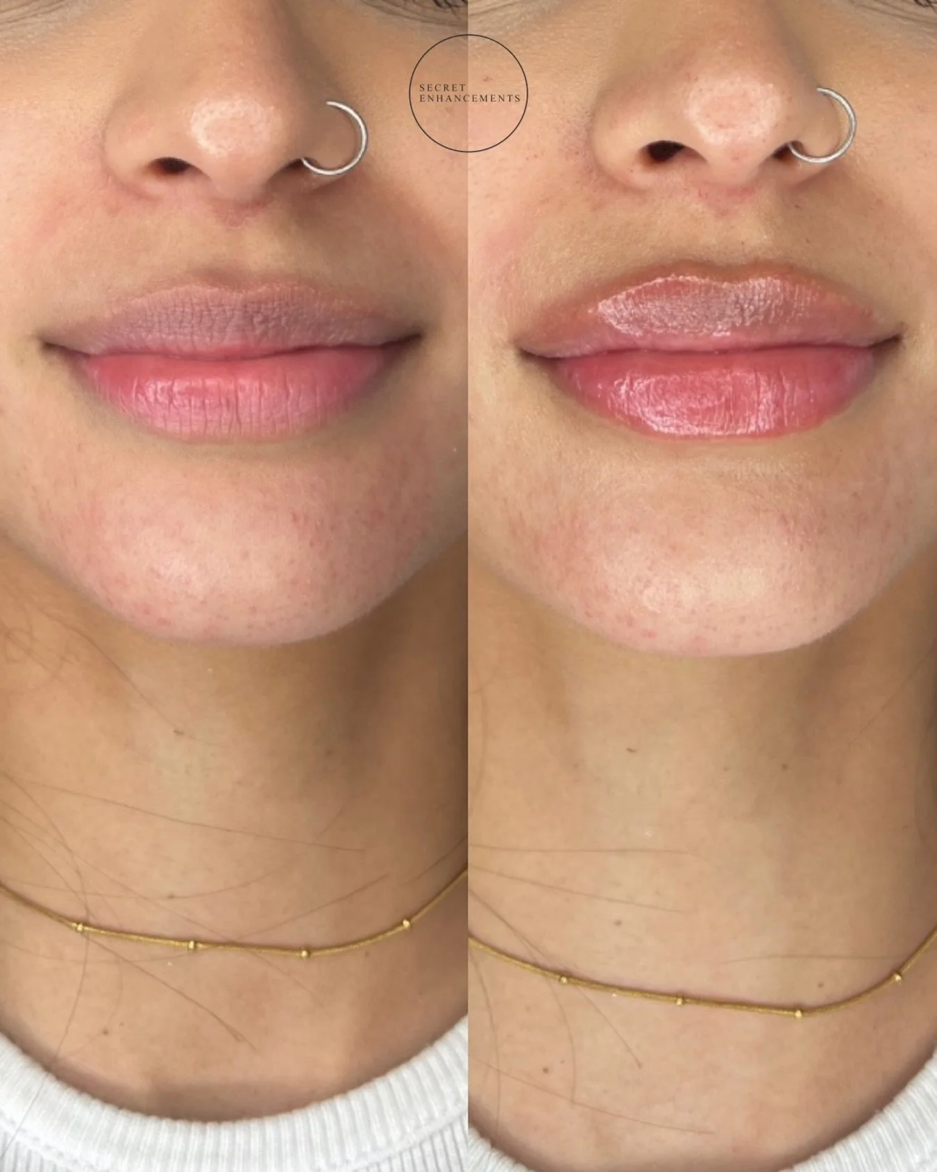 Stunning lips injected by Nurse Mollie in clinic today 🤩

Transform your lips with our natural lip filler treatment in Milton Keynes 💉

We specialise in creating subtle, natural enhancements.

📍 Clinic: Secret Enhancements, Milton Keynes
💋 Treatm
