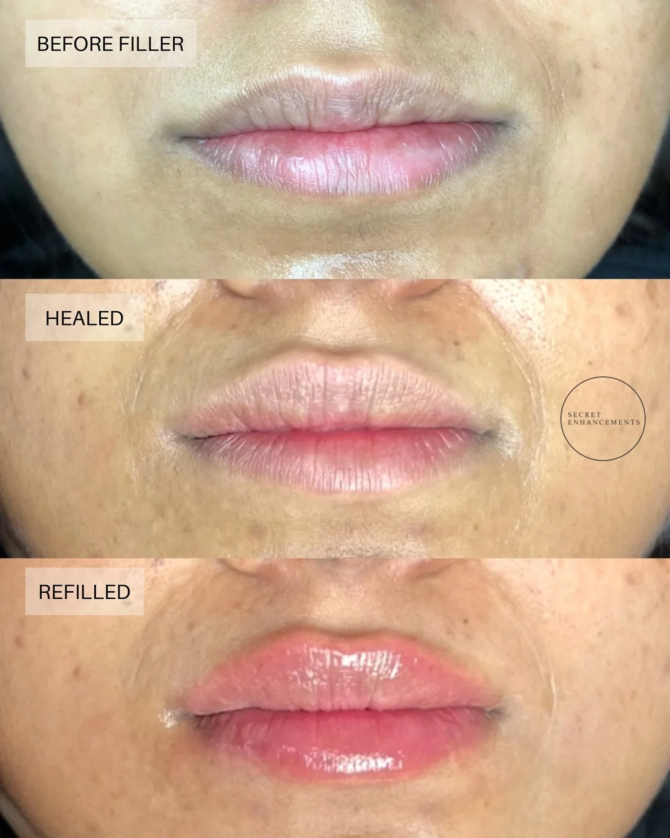 Can you believe these were first filled in 2019?

At our Milton Keynes aesthetic clinic, we specialise in subtle, natural lip enhancements built gradually over time. 

This beautiful transformation shows how the right techniques, not overfilling, cre