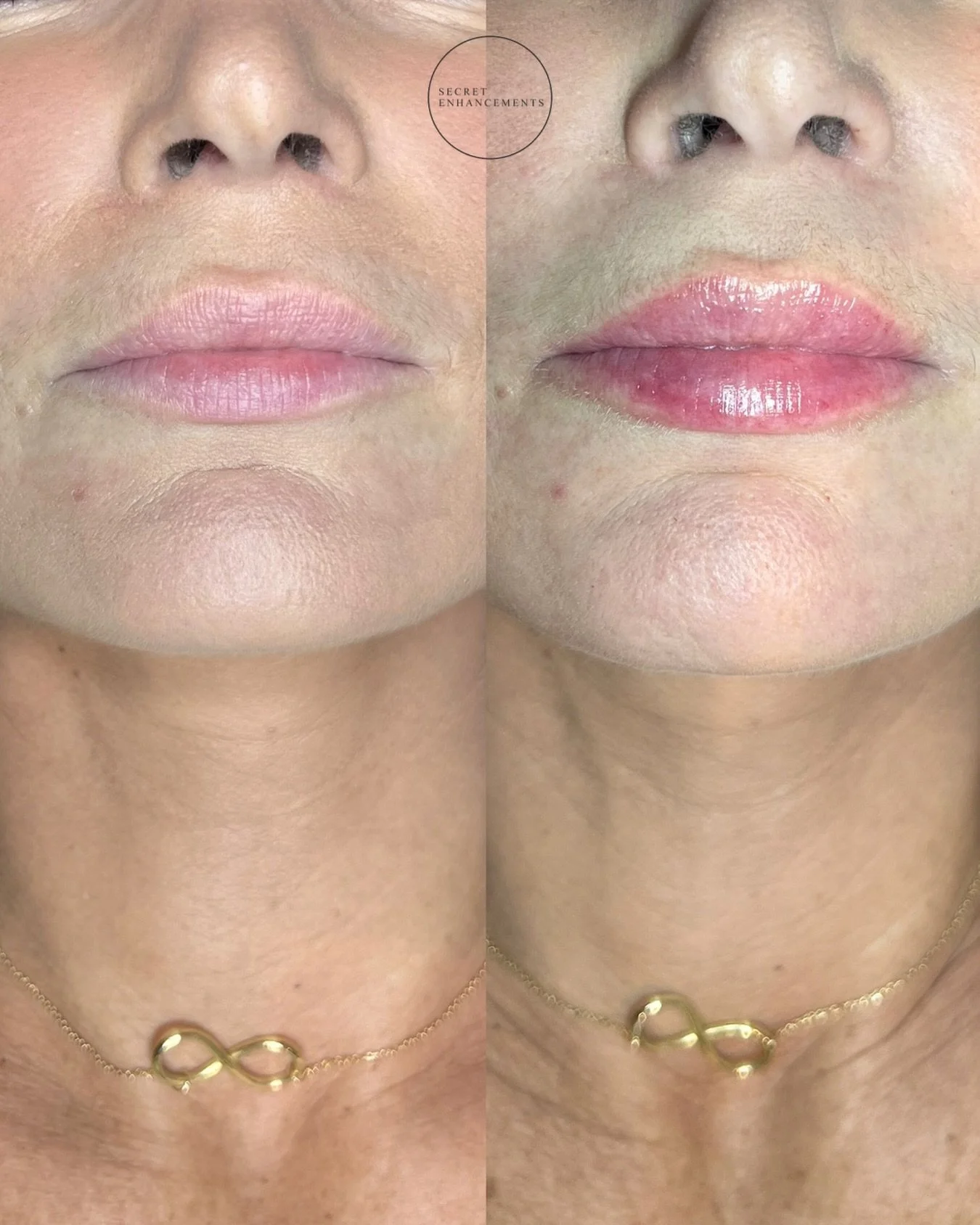 Proof that subtle enhancement &gt; overfilling&hellip; every single time!

Yes, it is possible to have natural-looking lip filler, welcome to my Milton Keynes clinic, where we enhance lips, not inflate them. 💋

Patient goals: soft, balanced definiti