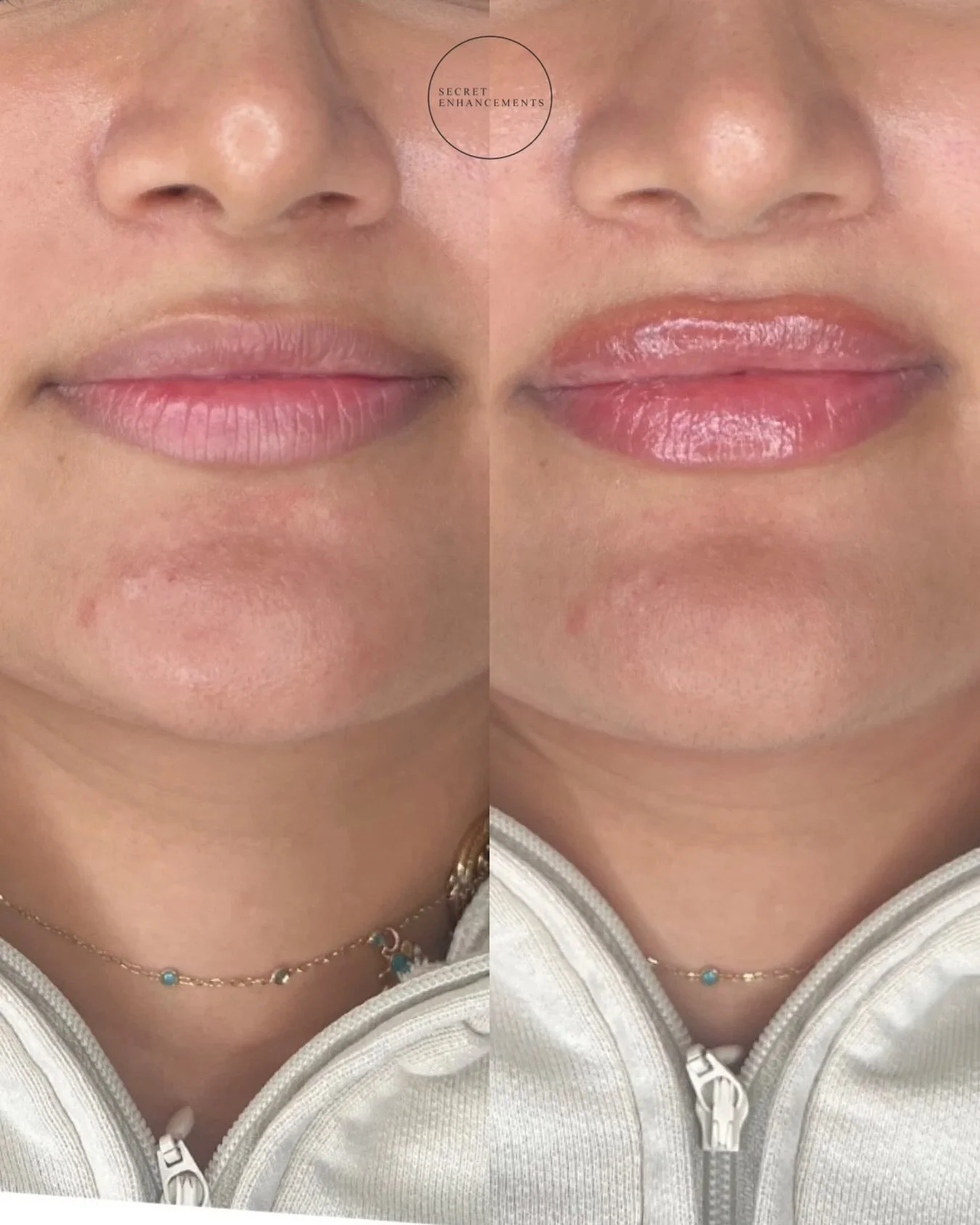 You&rsquo;d better be quick if you want your lips injected by Nurse Mollie! 💉 

We are proud to say we&rsquo;re fully booked for this month, but taking bookings for the new year already ✨

Transform your lips with our natural lip filler treatment in