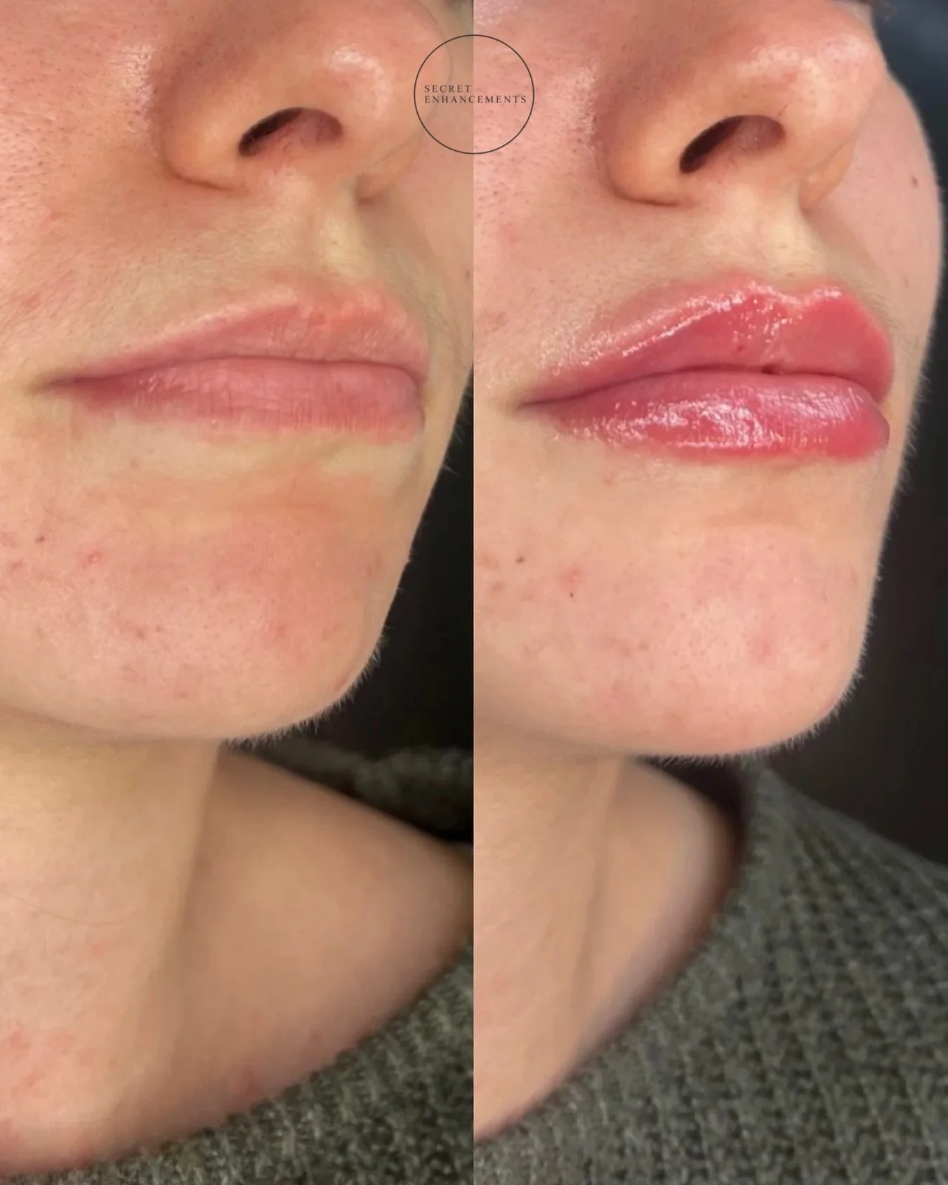 Nurse Mollie is on a roll! 💉 

We are proud to say we&rsquo;re fully booked for this month, but taking bookings for the new year already ✨

Transform your lips with our natural lip filler treatment in Milton Keynes with one of our medical profession