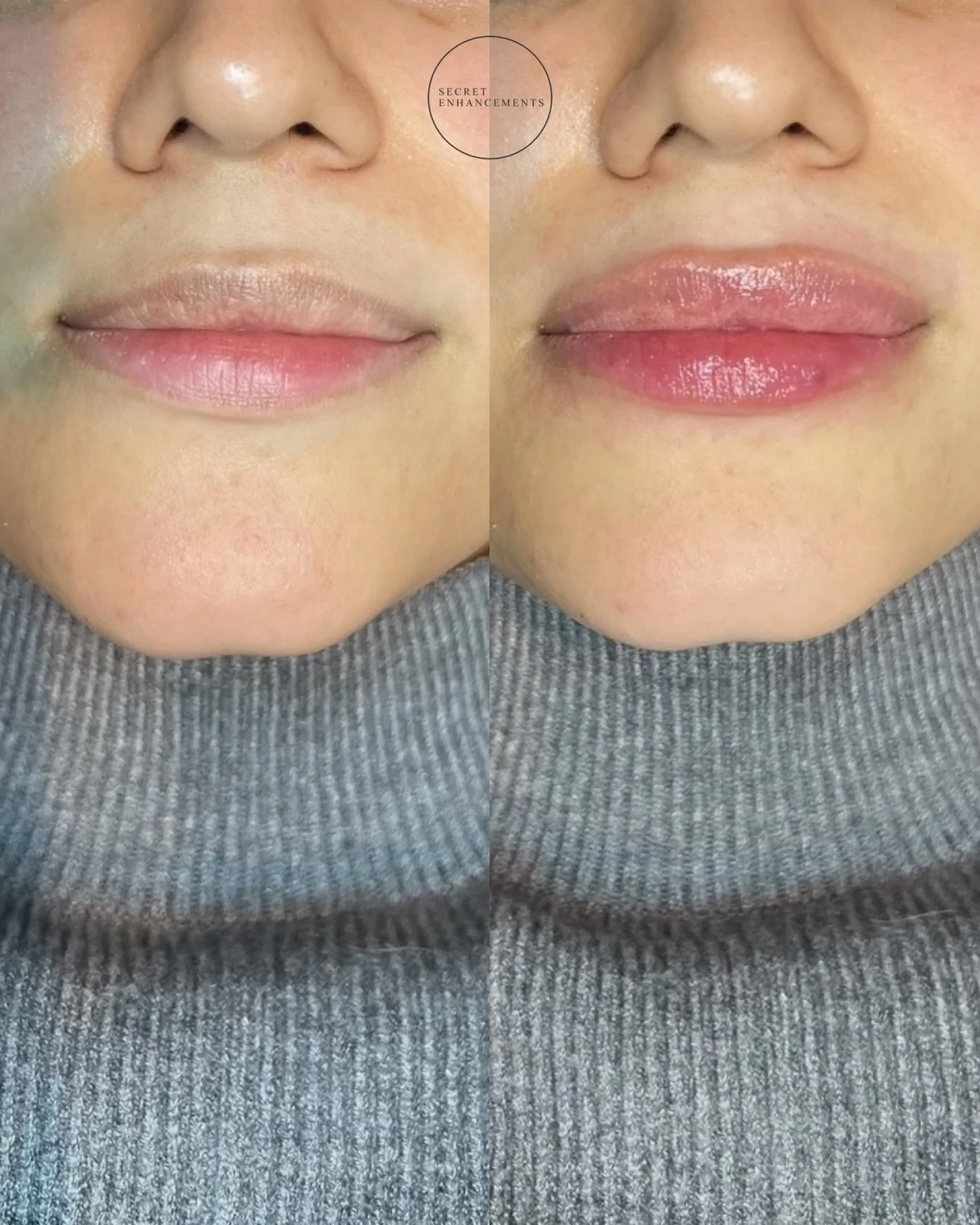 Another set of natural lips, injected with premium lip filler at our Central Milton Keynes clinic.

If you&rsquo;re unsure about how much is right for you, we include a consultation in all of our appointments! ❤️