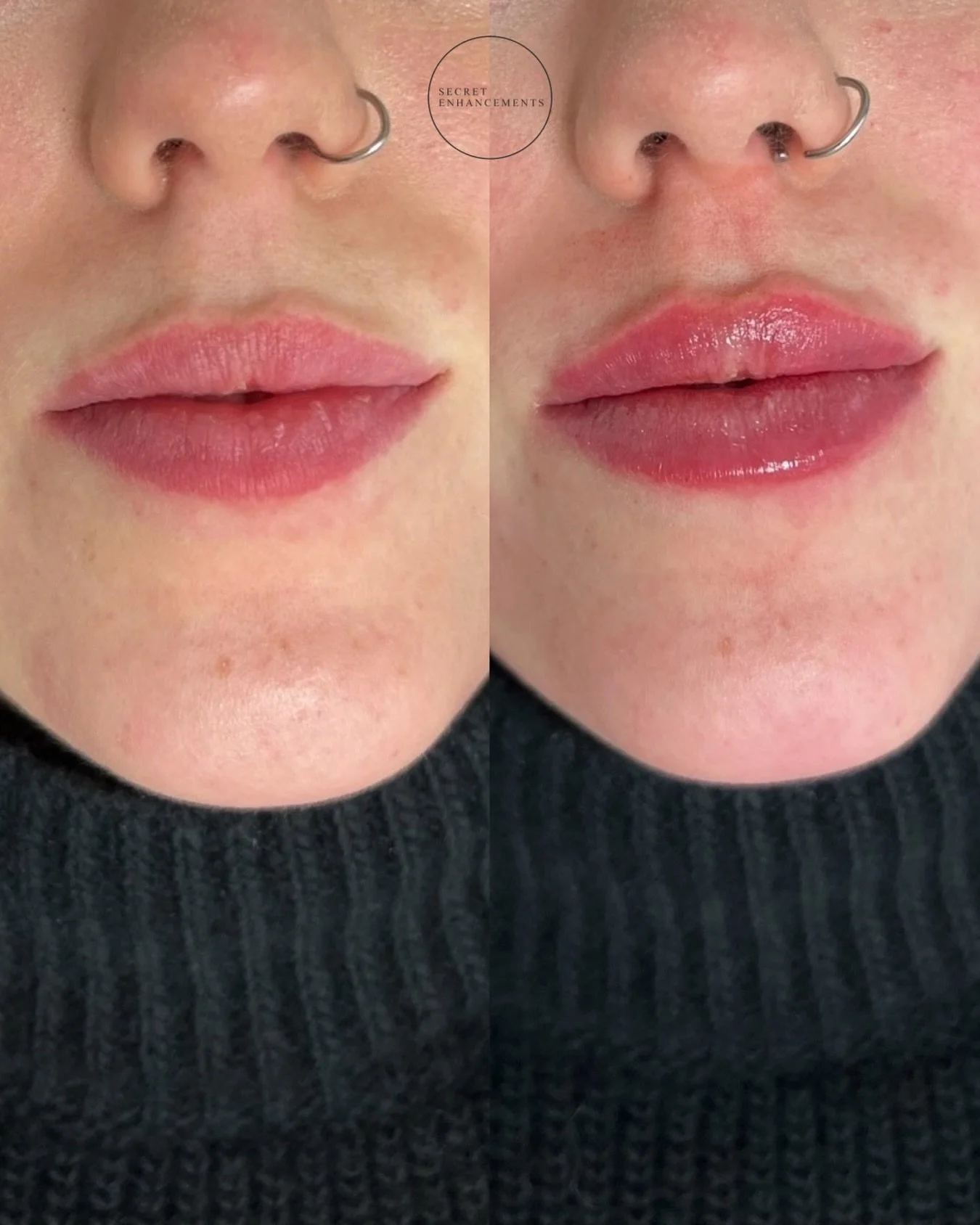 We specialise in natural lip filler, you can be rest assured that when visiting our clinic we always have your best interests at heart ✨

We believe lip filler should be to enhance your existing shape, either replenishing lost volume or adding a full