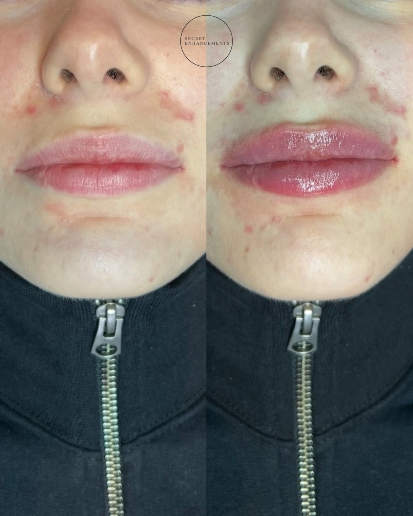 We specialise in natural lip filler, you can be rest assured that when visiting our clinic we always have your best interests at heart ✨

We believe lip filler should be to enhance your existing shape, either replenishing lost volume or adding a full